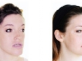 Fotos extraídas de artigo científico.  (Antes e depois – Cirurgia Orgognática e transposição da Gordura de Bichat para região de “bigode Chinês”.