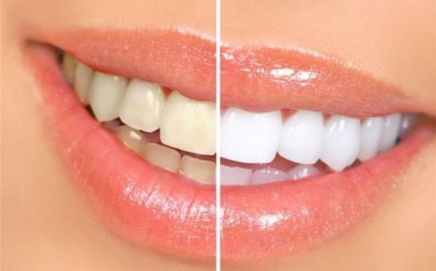 Alm de melhorar a esttica do sorriso, lminas de porcelana podem ser funcionais, diz dentista