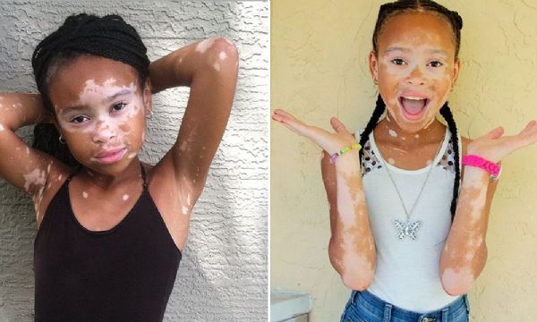 Após ser vítima de bullying, menina de 10 anos aceita sua essência e faz sucesso no mundo da moda
