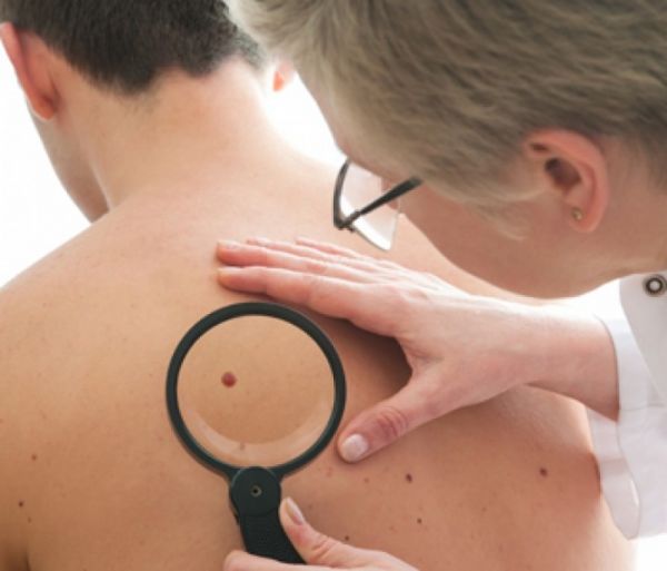 Dermatologistas de MT faro mutiro de exames para diagnosticar cncer de pele neste sbado