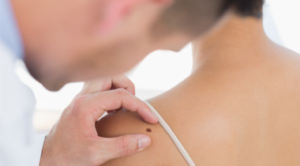 Novo tratamento para cncer de pele promete mais eficcia e menos efeitos colaterais