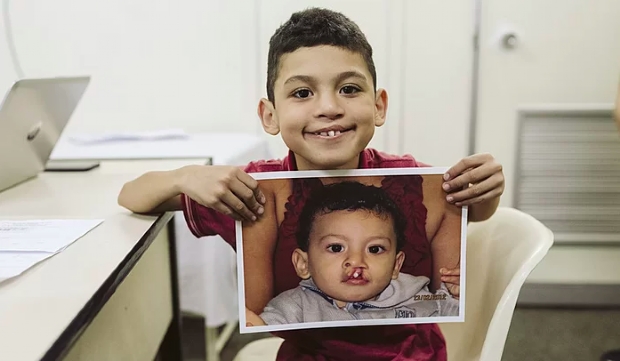 Cuiab Muitos Sorrisos  adiado, mas embaixador cria campanha virtual de doao para bebs com fissura labiopalatina