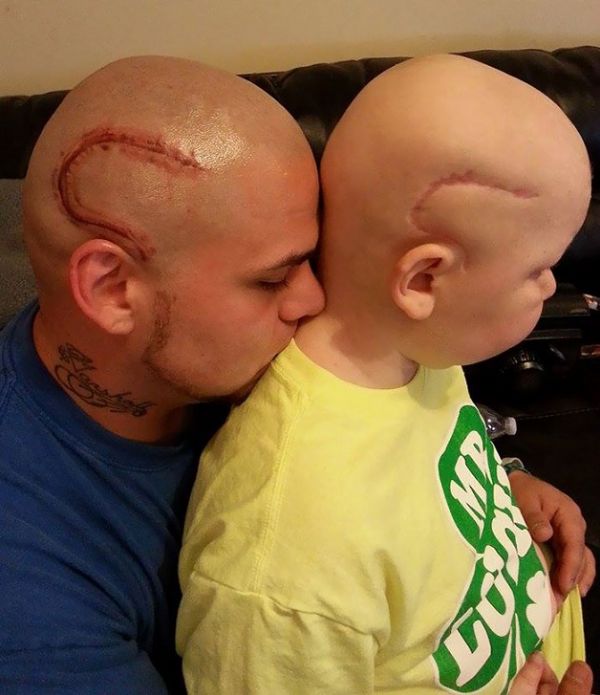 Pai tatua cicatriz igual  do filho operado a um tumor cerebral para melhorar sua autoestima