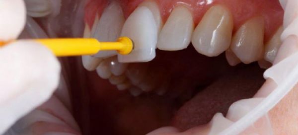 Lente de contato dental  feita de porcelana e corrige imperfeies de cor, manchas e desgaste