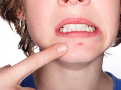 Dermatologista d sete dicas para evitar acne e cuidar da pele; Confira