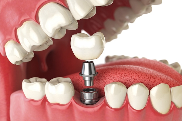 Cirurgiã Dentista fala sobre os implantes dentários: verdades e mentiras