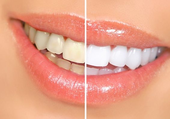 Evitar certos alimentos e bebidas contribuem para o clareamento dos dentes; Confira quais
